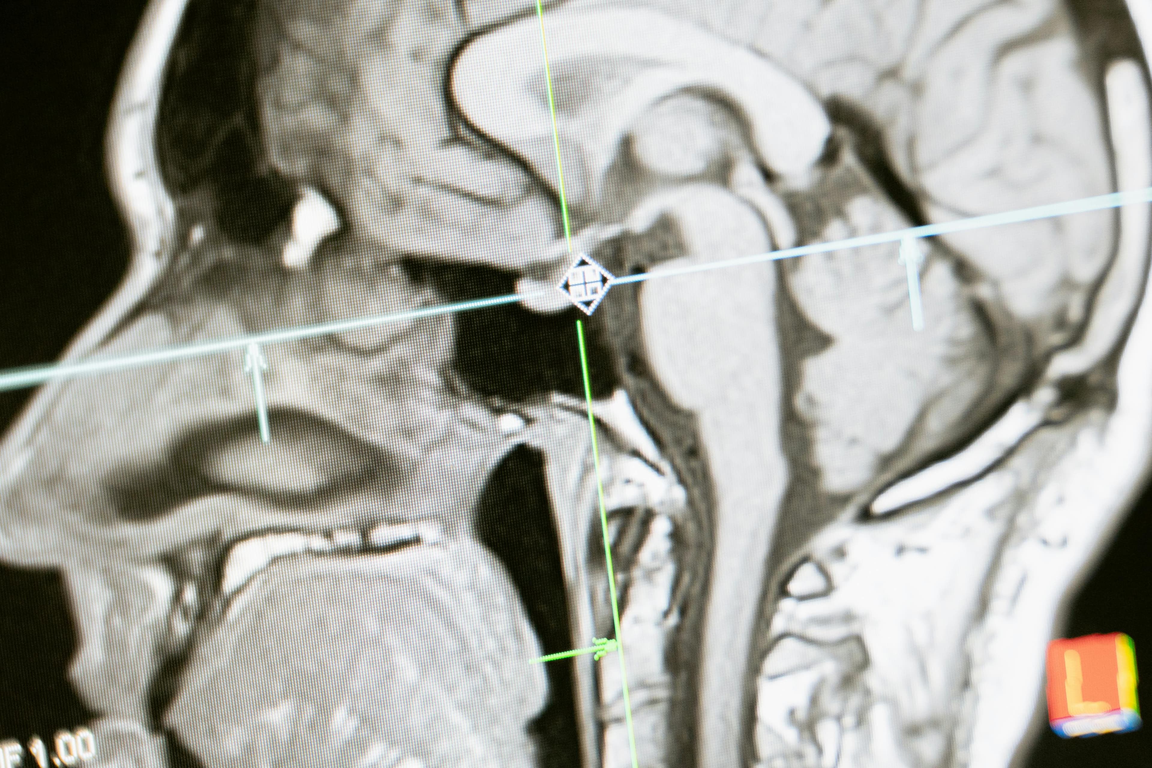 Cognitive and Behavioral Impact Analysis: Understanding the Link Between Brain Injuries and Behavior Image