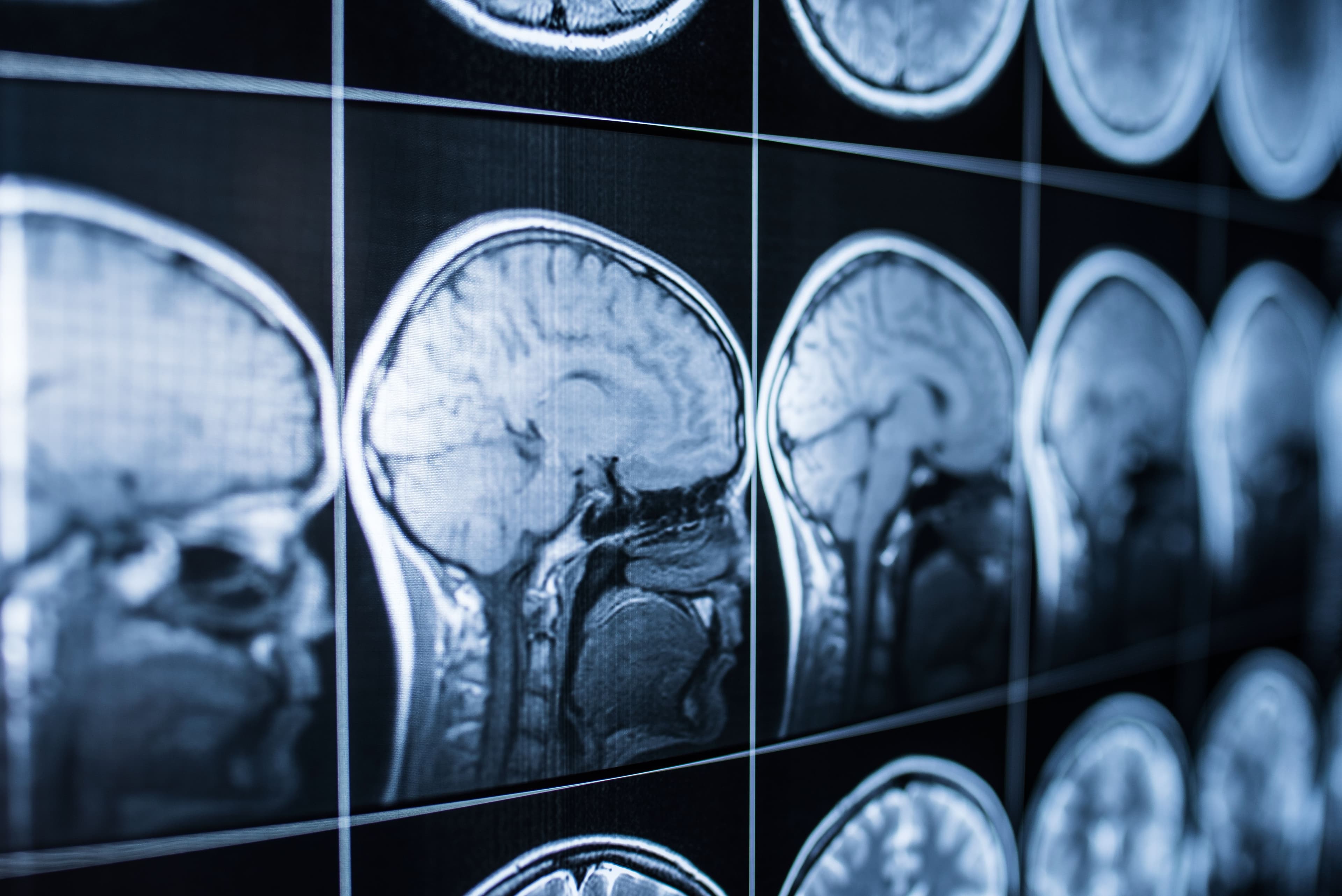 Cognitive and Behavioral Impact Analysis: Linking Brain Injuries to Behavioral Outcomes Image